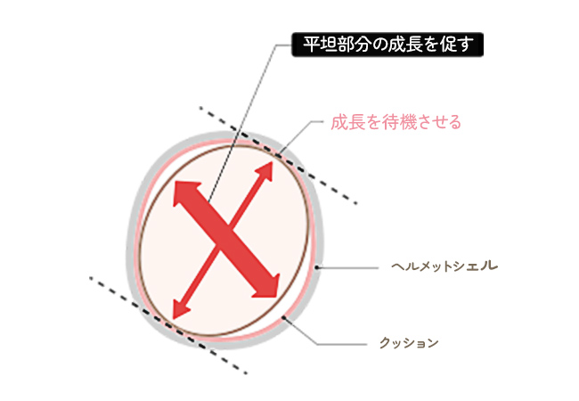 ヘルメット治療の原理